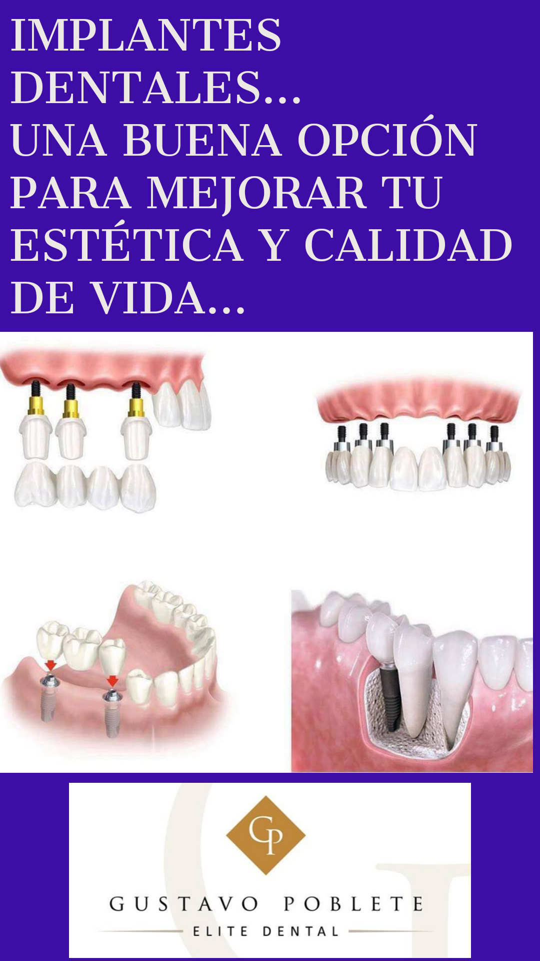 Los implantes tienen diferentes usos en la boca.